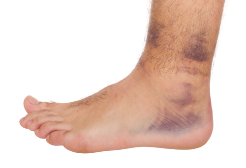 workers’ comp claims